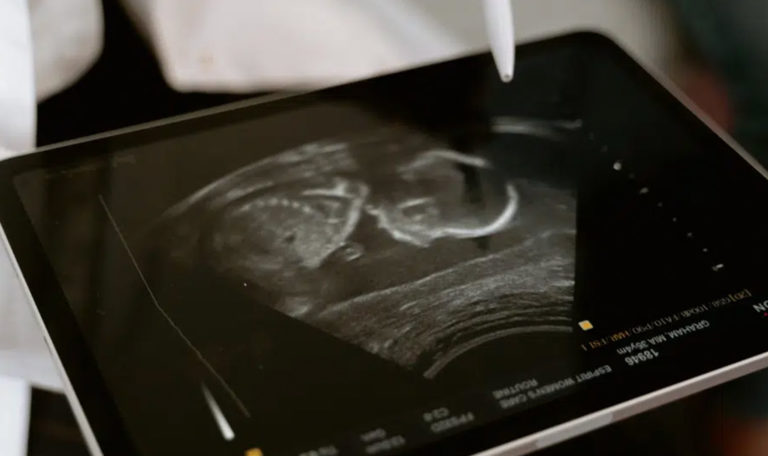 Ultrasound image of a foetus shown on an iPad.